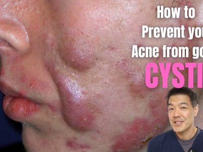 Cara Mengobati Cystic Acne