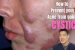 Cara Mengobati Cystic Acne