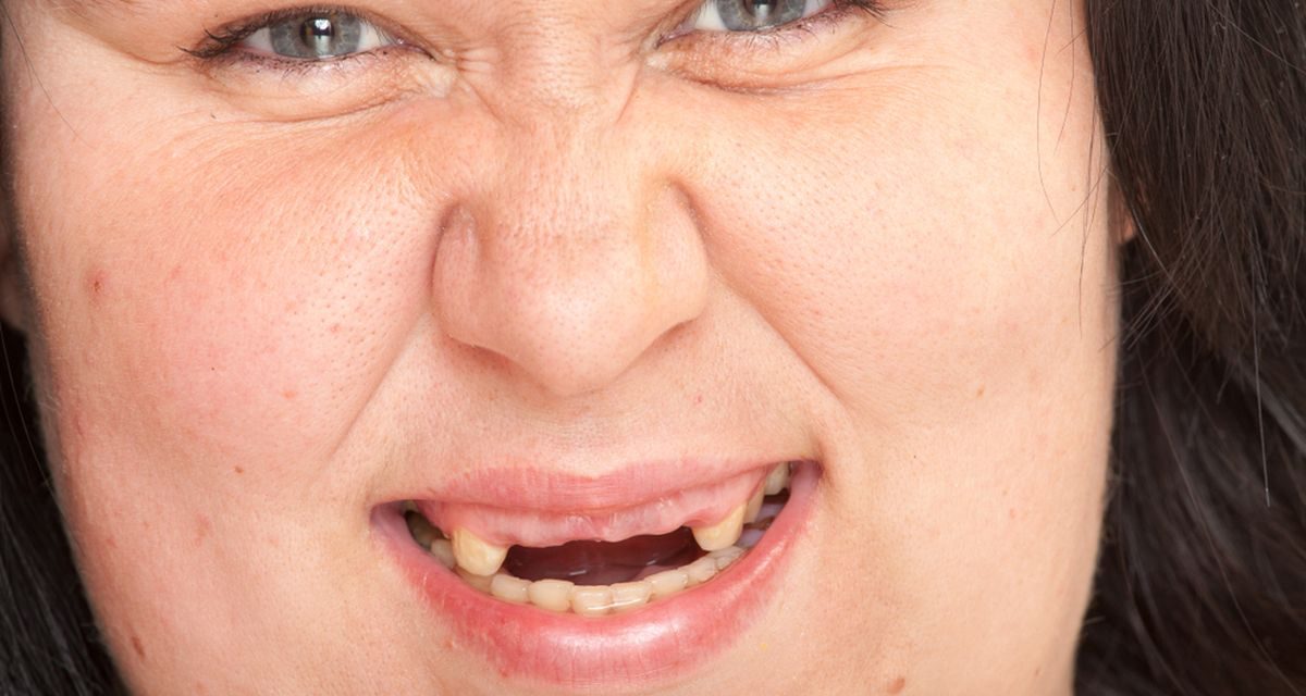 Anodontia, Kelainan Langka Seseorang Tidak Memiliki Gigi