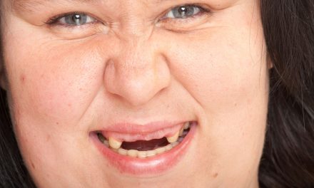 Anodontia, Kelainan Langka Seseorang Tidak Memiliki Gigi