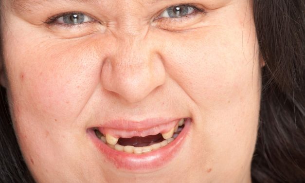 Anodontia, Kelainan Langka Seseorang Tidak Memiliki Gigi