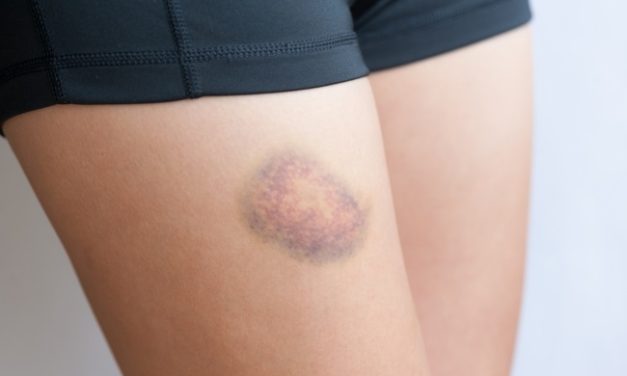 Penyakit Leukemia Ada Beberapa Jenis Yang Harus Di Ketahui