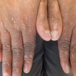 Epidermolisis Bulosa, Penyakit Langka Bikin Kulit Sangat Rapuh