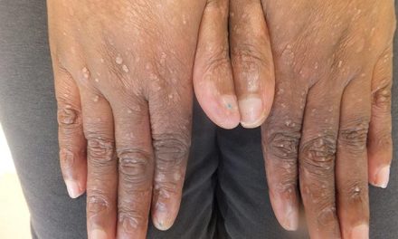 Epidermolisis Bulosa, Penyakit Langka Bikin Kulit Sangat Rapuh