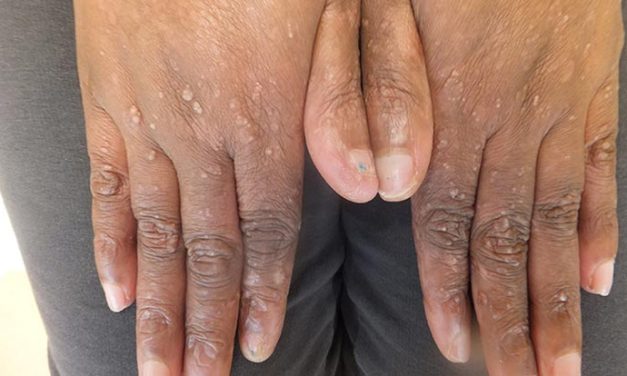 Epidermolisis Bulosa, Penyakit Langka Bikin Kulit Sangat Rapuh