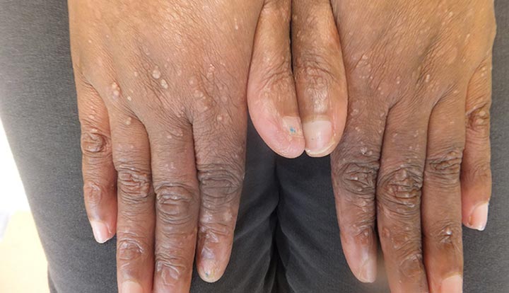 Epidermolisis Bulosa, Penyakit Langka Bikin Kulit Sangat Rapuh